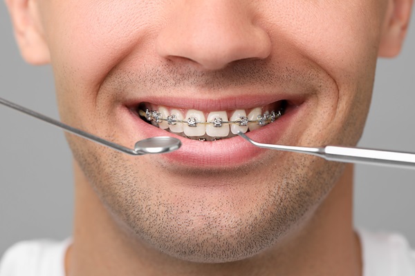 How Often Do Braces Need To Be Tightened?