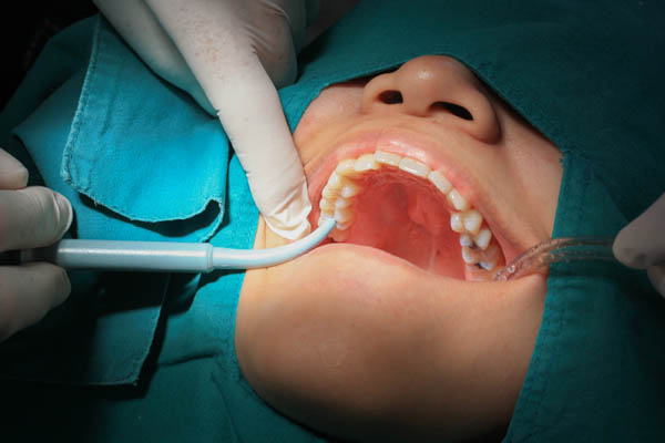 What To Know About Composite Dental Fillings