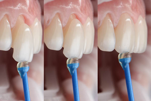 Dental Composite Porcelain Veneers Resin – Light Cure For Anterior Teeth Whitening