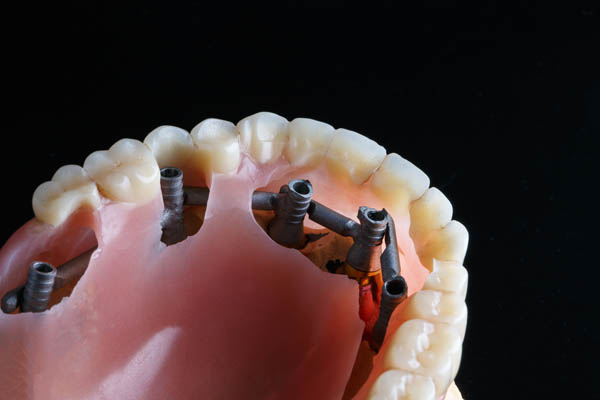 Implant Supported Dentures Plano, TX