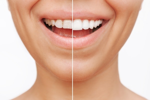 Can Dental Veneers Cover Imperfections On Teeth?